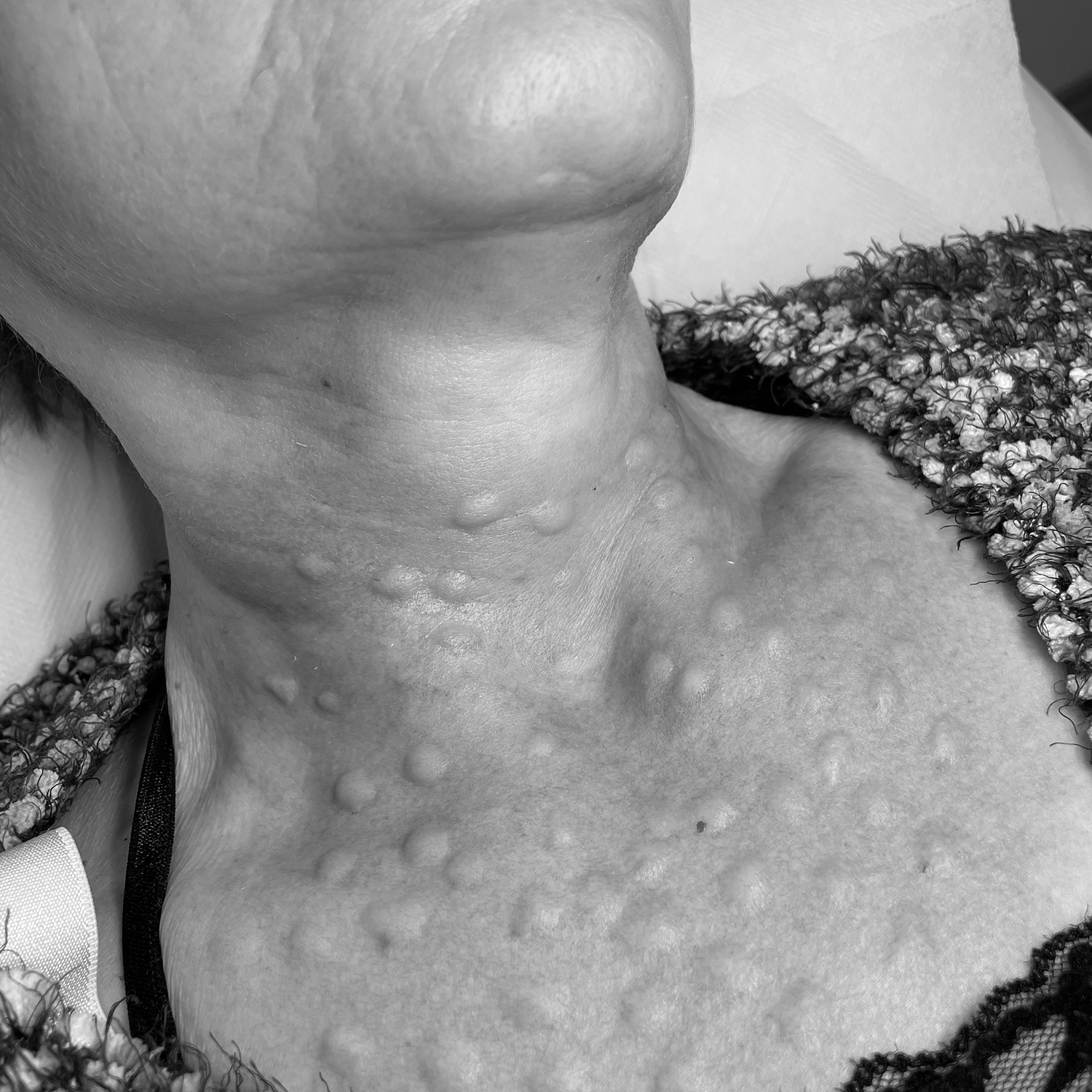 swiper-Mezoterapia igłowa